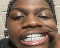 The rapper has million dollars smile.